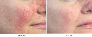 peel before chemical microdermabrasion peels skin rosacea acne sensi pca redness texture damage skincare tca sun hyperpigmentation services light facial