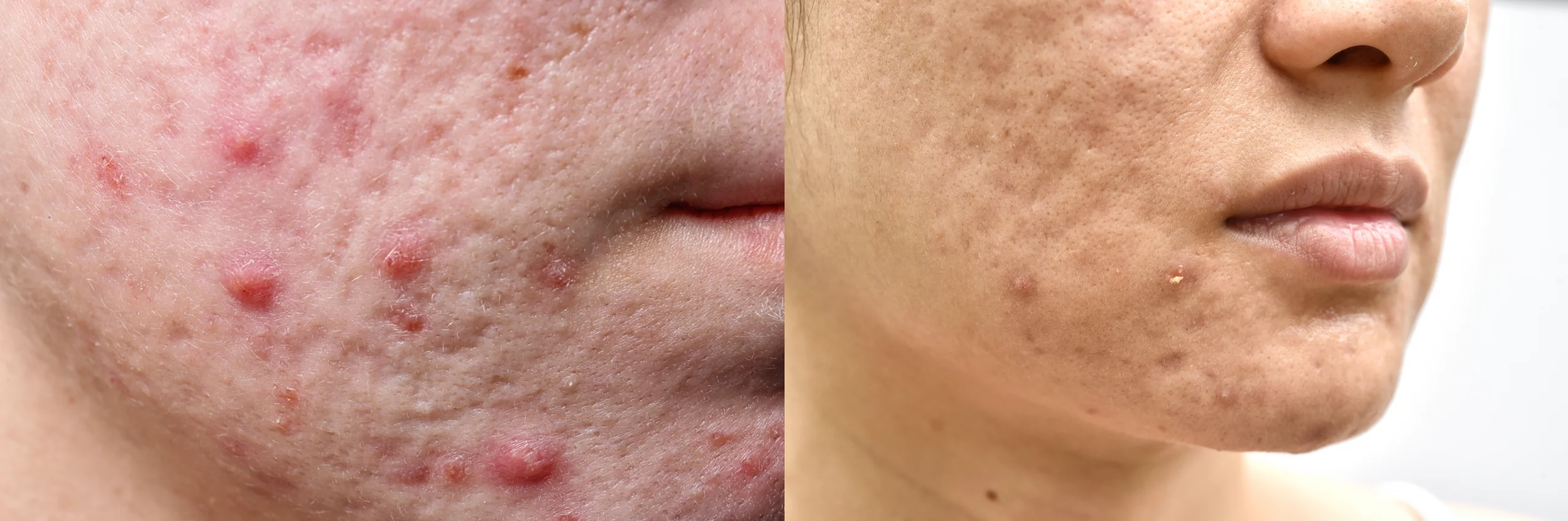 Cystic Acne Scars What They Are And How To Treat Them