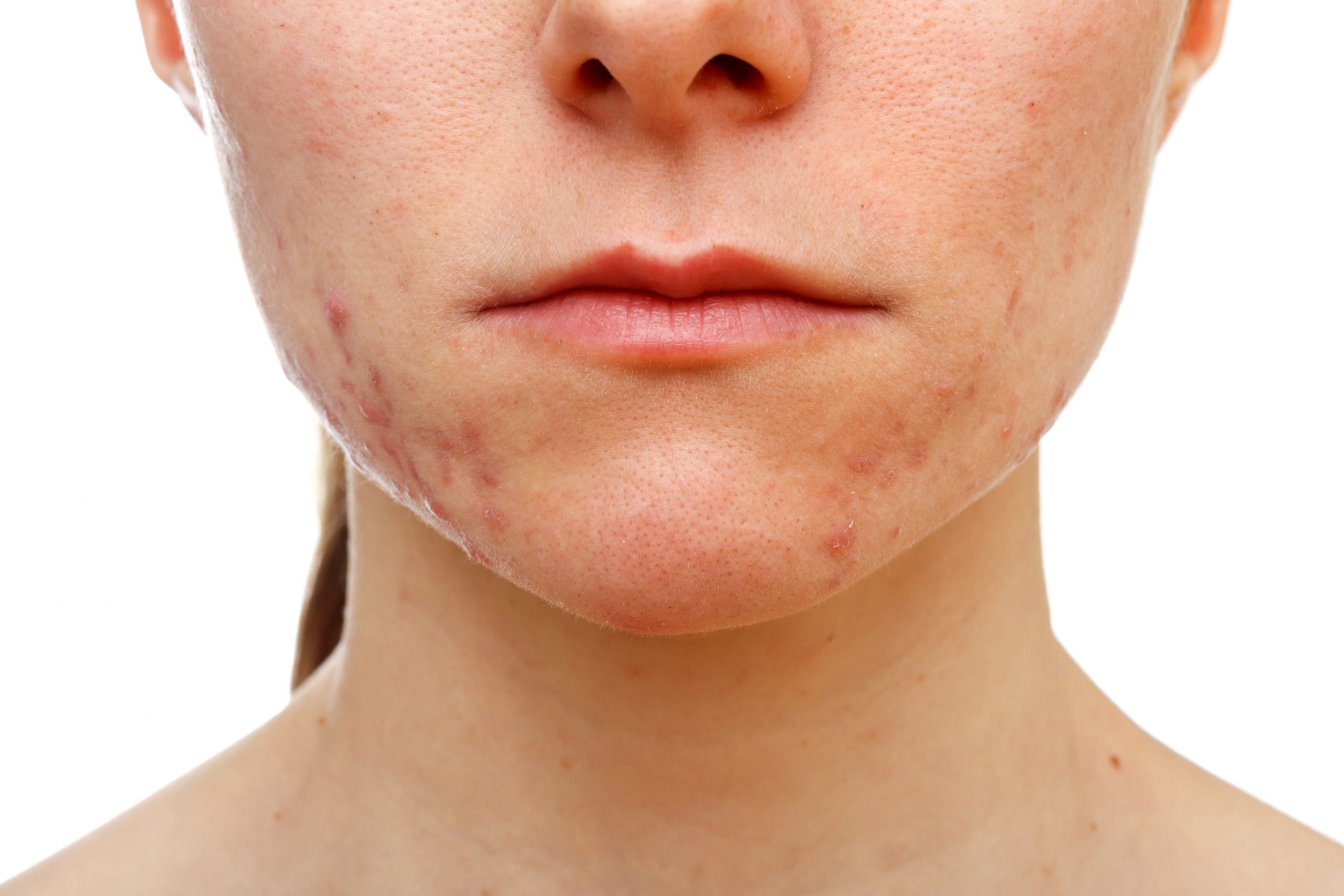 Natural Face Peels For Acne Scars 4 Treatments You Can Try